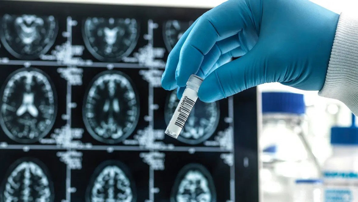 AB, 'tarihi' Alzheimer ilacına ruhsat vermedi