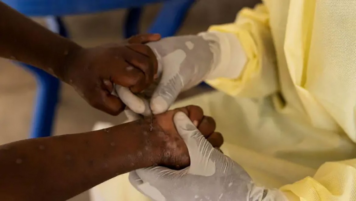 Maymun çiçeği virüsü nedir, nasıl bulaşır?..